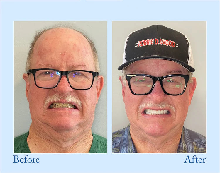 Smileasego - Premium Denture