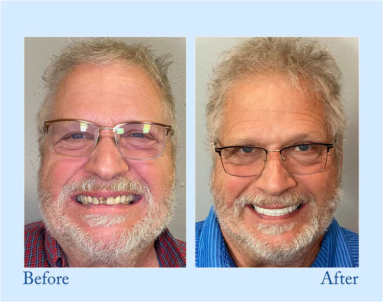 Smileasego - Premium Denture