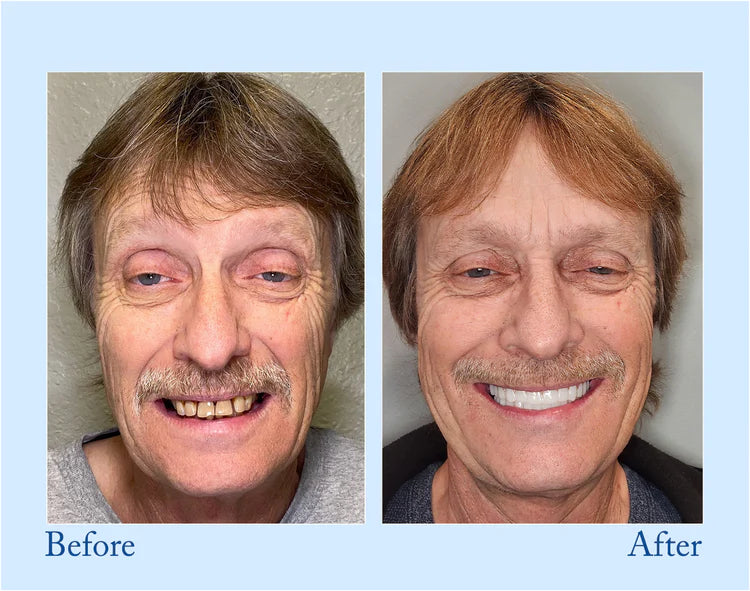 Smileasego - Premium Denture