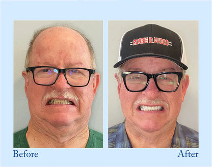 Smileasego - Premium Denture