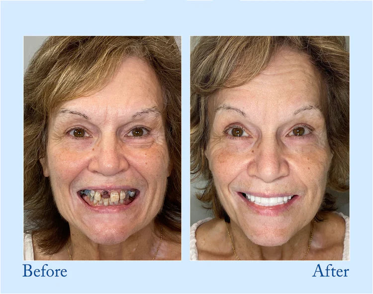Smileasego - Premium Denture